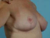 Patient # 16733 After Photo # 4